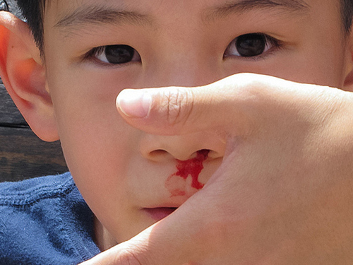 Что делать, если у ребенка носовое кровотечение?.