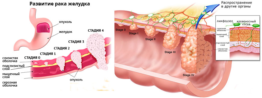 Рак кишечника метастазы прогноз. Опухоль желудка 4 стадия. Карцинома желудка 4 стадия. Злокачественное новообразование желудка. Раковая опухоль желудка.