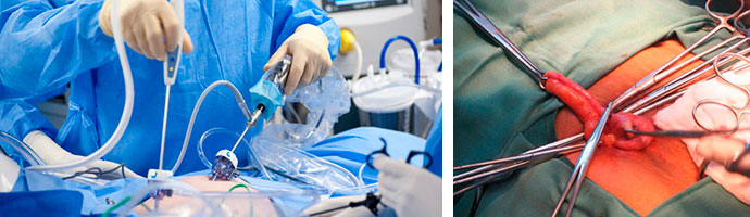 лапароскопия и обычная операция