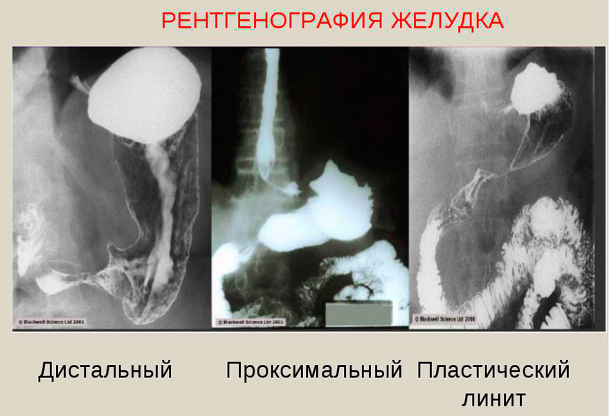 рентгенография желудка