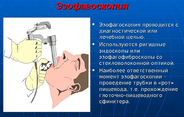 процедура эзофагоскопия